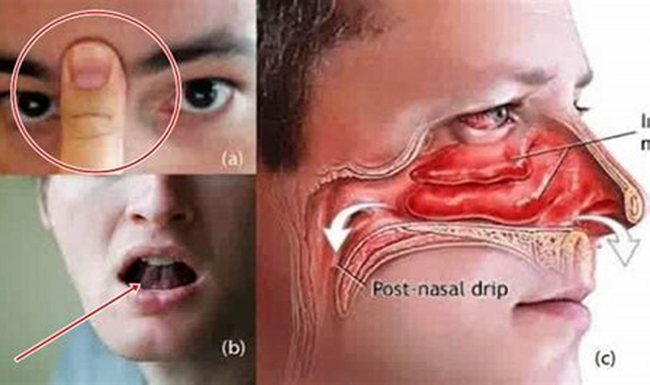 Cara Mengatasi Mampet Hidung